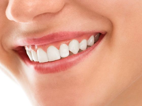 Retenedores dentales ¿Qué son y para qué sirven? - Ortodoncia en Gijón - Clínica Beatriz Vega