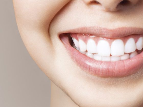blanqueamiento dental en gijón