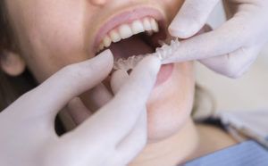 Qué es la ortodoncia invisible ortodoncia invisiblelign. Dentistas en Gijón