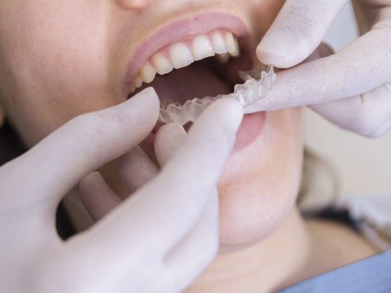 Qué es la ortodoncia invisible ortodoncia invisiblelign. Dentistas en Gijón