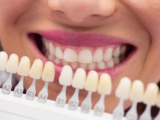 Beatriz Vega. Las manchas dentales pueden corregirse de manera sencilla en la mayoría de casos.