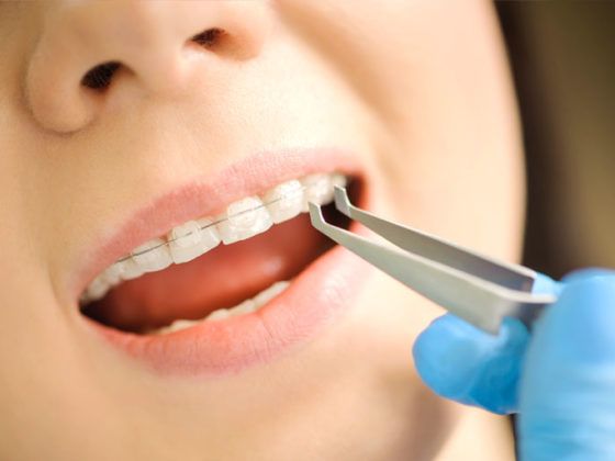 a veces pueden ocurrir urgencias de Ortodoncia en Gijón. En nuestra Clínica dental, disponemos de dentistas expertos en urgencias dentales
