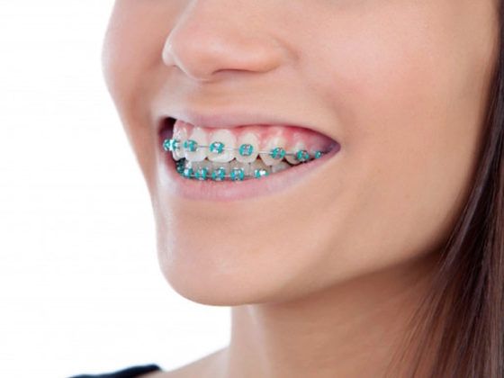Clínica Dental Beatriz Vega. La ortodoncia no produce sensibilidad dental como tal.