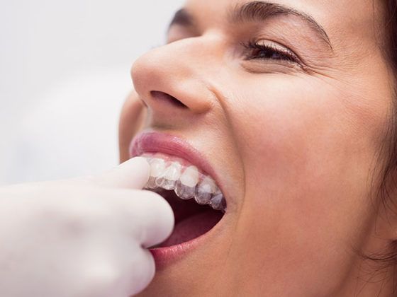 Persona alinea sus dientes sin molestias en la Clínica Dental Beatriz Vega