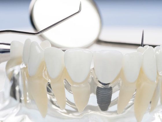 Clínica Beatriz Vega. Implantes dentales de carga inmediata en forma de muestra