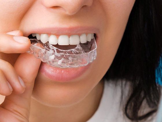 Clínica Dental Beatriz Vega. Causas y tratamiento de los dientes desalineados